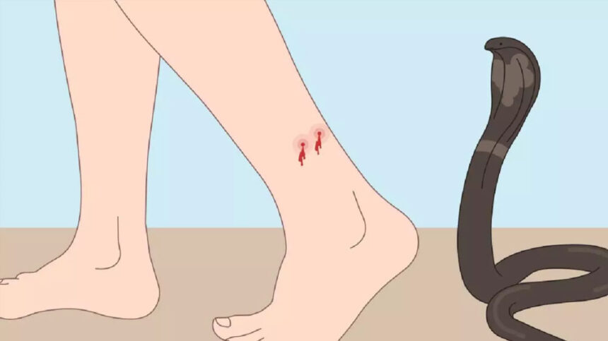 Snakebite